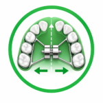 PALATAL EXPANDER TO IMPROVE ARCH FORMS
