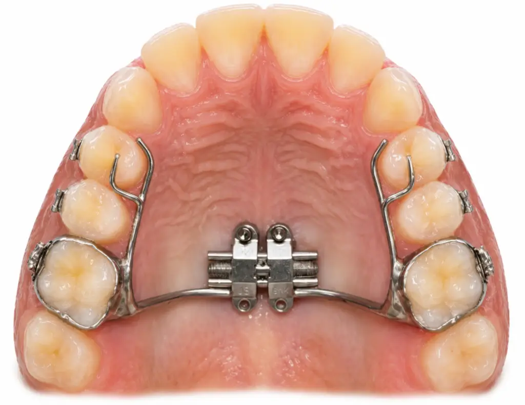 marpe- MINI IMPLANT RAPID PALATAL EXPANDER